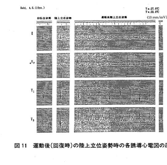 図 12 運動後 ( 回復時 )の仰 臥位安静姿勢時の各誘導心電 図の原波形