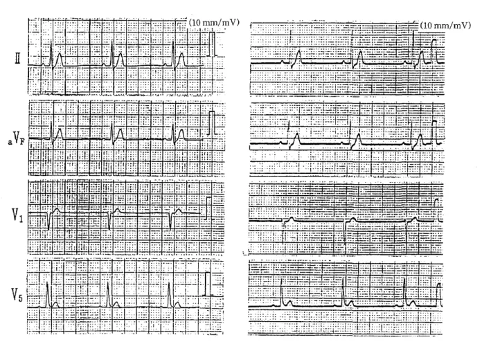 図 6 は,ECG t e s tpat t e r ns i mi l ar t er G‑1 02A による ECG anal yz e r 503 FA と多用途 テ レメー タ との各誘 導基本波形 ( H u m f i l t erof f ,Dr i f t 補正 of f ) の比較 を示 した｡各誘 導基本波形 ( Ⅰ Ⅰ ,a V F , Vl ,V 5) とも両者間 にお ける波 形 pat t e r n に著 しい差 はみ られなか った｡一 方,記録 された各誘 導基本波形 の 
