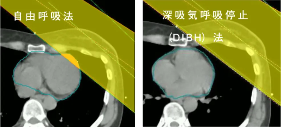 図 1　自由呼吸法と深吸気呼吸停止（DIBH）法の治療計画画像の比較 自由呼吸法に対して DIBH 法は肺に空気を取り込むことで，心臓と胸壁の距離を拡大 させ，心臓への線量を低減する照射技術である．自 由 呼 吸 法 深 吸 気 呼 吸 停 止（DIBH）法 呼吸性移動を伴った腫瘍に対する高精度呼吸管理システムを代替する廉価な簡易呼吸管理システム照射法の検討（地方独立行政法人京都市立病院機構京都市立病院　放射線技術科）田中　和徳　　小菅　友裕　　福本　賢大　　宮井　明津川　和夫要　　　旨