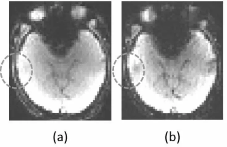 Figure 1.  Images at three echoes:（a）image at TE 1  and（b）image at TE2. The dotted circle indicates a region that  represents signal decay while TE increases.