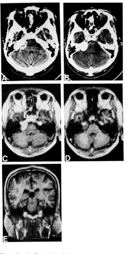 Fig. 2 Case 2. Tentonal meningioma. A : Plain CT (axial section) C : MRI‑SE (axial section) E : MRI‑IR (coronal section) B '. CE CT (axial section) D : MRI‑IR (axial section)