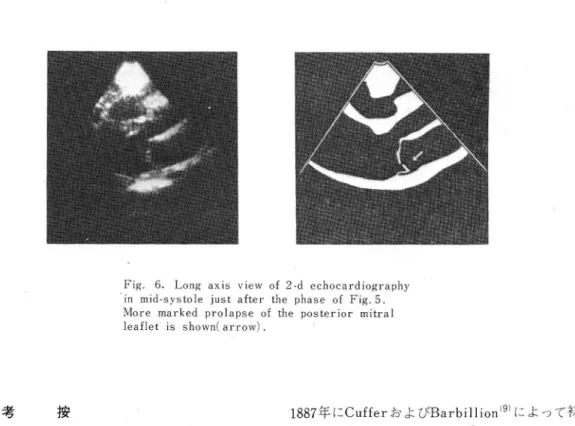 Fig. 6. Long axis view of 2‑d echoeardiography in mid‑systole just after the phase of Fig.5