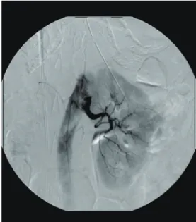 図 29a 腸間膜・腸管壁の動脈瘤 図 29b 腎内の葉間動脈の動脈瘤