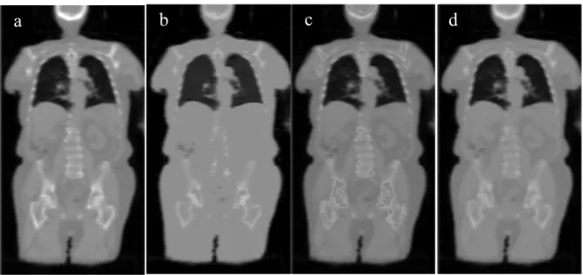 Fig 1.7 Illustration of attenuation maps generated using the different energy-mapping  techniques: (a) Scaling, (b) Segmentation, (c) Hybrid and (d) Bilinear methods 10) 