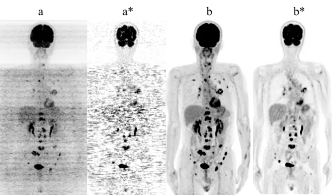 Fig 1.8 The comparison between FBP method and OSEM method: (a) FBP and (b)  OSEM methods