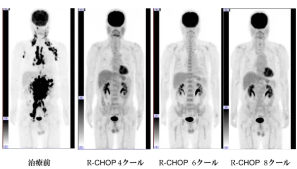 Fig 2.4 The effect of treatment in the case of the malignant lymphoma. 