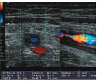 Fig. 4    Evaluation of percent stenosis  （ linear probe , two - dimensional ）