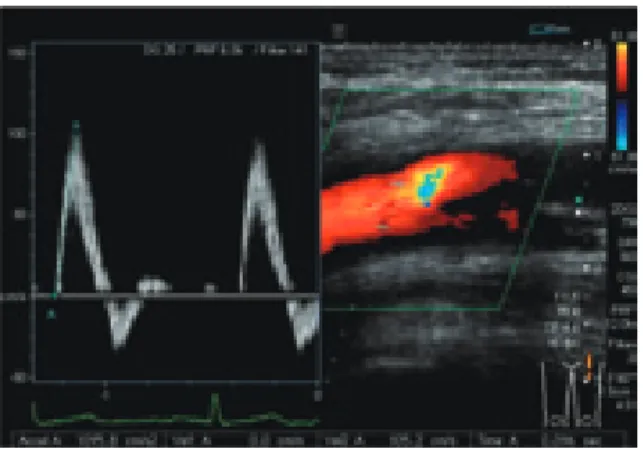 Fig. 6 b    Measurement of saccular type aneurysm  diameter