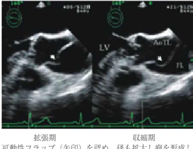 Fig. 2   ドプラ法による表示（左 : カラードプラ法．