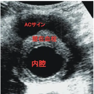 Table 2  瘤の鑑別診断 ・部位別：胸部（thoracic; TAA: 上行，弓部，下行）      胸腹部（thoracoabdminal; TAAA）      腹部 （abdominal; AAA） ・形態別： 真性瘤 ; 動脈壁構造を持ち瘤形成        （胸部 4