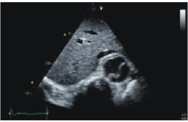 Fig. 12  大動脈解離の形態