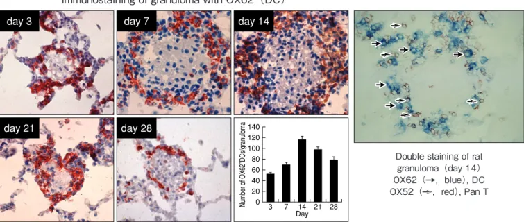 Figure 4.   サルコイドーシス患者の肺生検およびリンパ節標本の切片における免疫染色Immunostaining of granuloma with OX62（DC）