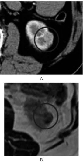 Fig. 1. Preoperative image ﬁndingsof cas e 1 : Contrast enhanced CT scan showed a less enhanced small renal mass in the venous phase (A : circle)