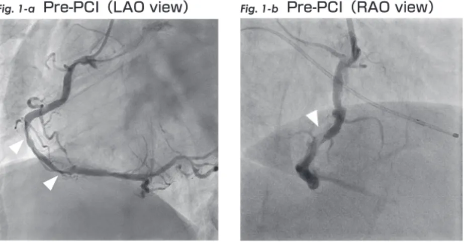 Fig. 1-a Pre-PCI（LAO view） Fig. 1-b Pre-PCI（RAO view）
