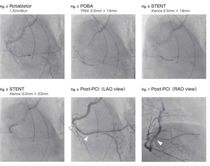 Fig. 5 STENT Fig. 6 Post-PCI（LAO view） Fig. 7 Post-PCI（RAO view）