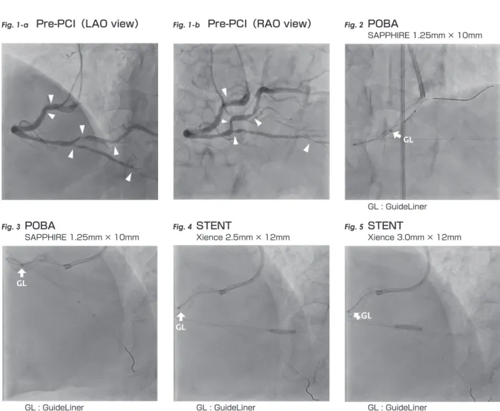Fig. 1-a Pre-PCI（LAO view） Fig. 1-b Pre-PCI（RAO view） Fig. 2 POBA