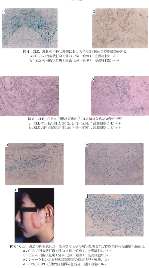 図 4：CLE，SLE の円板状紅斑における抗 CD4 抗体免疫組織染色所見 a：CLE の円板状紅斑（図 2a と同一症例）：浸潤細胞に 3/ ＋ b：SLE の円板状紅斑（図 2b と同一症例）：浸潤細胞に 4/ ＋ 図 5：CLE，SLE の円板状紅斑の抗 CD8 抗体免疫組織染色所見 a：CLE の円板状紅斑（図 2a と同一症例）：浸潤細胞に 4/ ＋＋ b：SLE の円板状紅斑（図 2b と同一症例）：浸潤細胞に 2/ ＋＋ 図 6：CLE，SLE の円板状紅斑，ならびに SJS の環状紅斑と抗