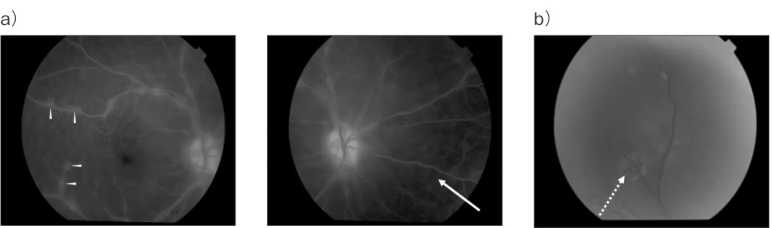 Figure 3.  Eye fundus at the initial visit (ﬂuorescein angiography) (a) and during an exacerbation (b).