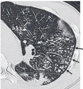 Fig. 2 Granulomas  are  formed  within  and  around  the  bronchioles, that is, terminal bronchioles ( ), respiratory  bronchioles ( ) and to the extent of alveolar ducts ( )