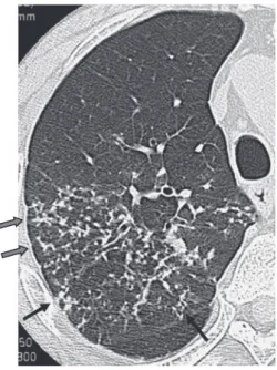 Fig. 7 A case showing widely disseminated acinar lesions,  which  are  not  distributed  regularly,  in  other  words,  in  a  centrilobular manner