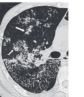 Fig. 11 Acino-nodose lesion, described  ﬁrstly  by  Aschoff.  On  CT  (left)  small  nodules   (acinar   lesions)   are   clustered  within  a  secondary  lobule,  mimicking  a  bunch  of  grape  ( )