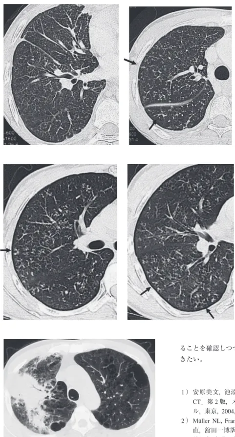 Fig. 12 A case of typical miliary  tuberculosis. In the lower lung ﬁeld  (left),  tiny  nodules  are  scattered  in  a  random  manner,  suggesting  hematogenous   dissemination