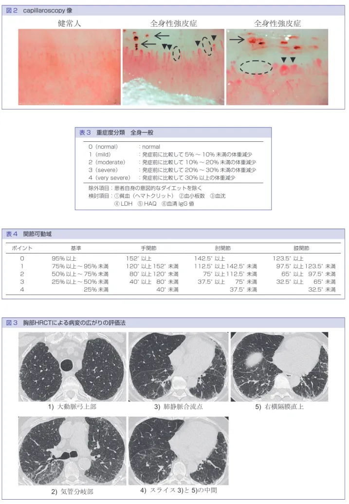 図 2　capillaroscopy 像 表 3　重症度分類　全身一般 0（normal） ：normal 1（mild） ：発症前に比較して 5% ～ 10% 未満の体重減少 2（moderate） ：発症前に比較して 10% ～ 20% 未満の体重減少 3（severe） ：発症前に比較して 20% ～ 30% 未満の体重減少 4（very severe） ：発症前に比較して 30% 以上の体重減少 除外項目：患者自身の意図的なダイエットを除く 検討項目：  ①貧血（ヘマトクリット）　②血小板数　③血沈