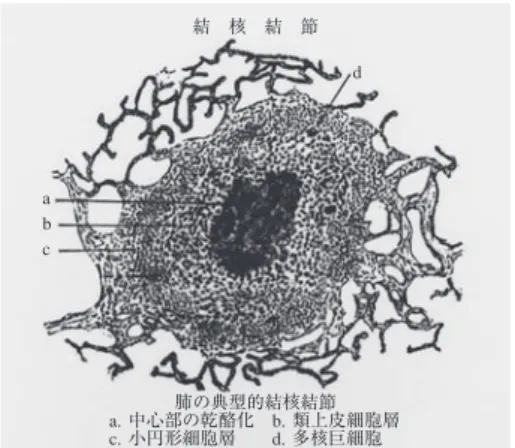 図 1 岩崎が「結核の病理」で，肺内の乾酪性肉芽腫（結 核結節）の病理像として描いたシェーマ。中心部に結 核菌を内部に含む乾酪壊死巣があり，これを単球系細 胞を起源とする多核巨細胞・類上皮細胞が層状に取り 巻く，さらにその最外側をリンパ球が層状に取り巻く 三重構造である。 dミニ特集「肺抗酸菌症の画像」肺結核の CT画像と病理所見尾形 英雄 要旨：本邦の肺結核画像所見の研究は，未治療肺結核患者剖検肺の病理形態学を基礎に完成した。これを基に肺結核の乾酪性肉芽腫が，滲出性反応期・繁殖性反応期・増殖性反応期・硬化