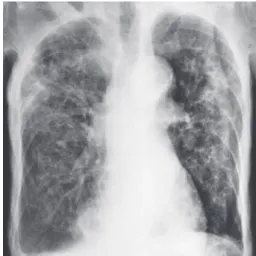 図 3 - 2 入院時の胸部 CTスキャン。両側肺に広範な濃淡のある浸潤陰影と胸水がみられる。気腫性肺疾患が 元々あるため，右上葉の矢印部分が空洞性病変か不明。 図 3 - 1 自宅で意識不明状態で発見され救 急病院に入院した 83歳男性の胸部単純写真。両側肺に広範な浸潤陰影，胃液検査で抗酸菌塗抹陰性（後に培養陽性）だったため，肺炎で治療を受けた。図2 左側は高齢者結核患者の肉芽腫，右側は26歳の若年者結核患者の肉芽腫の病理像。若年者は単球系細胞・リンパ球とも細胞成分が豊富で密集している。高齢者の細胞間はル