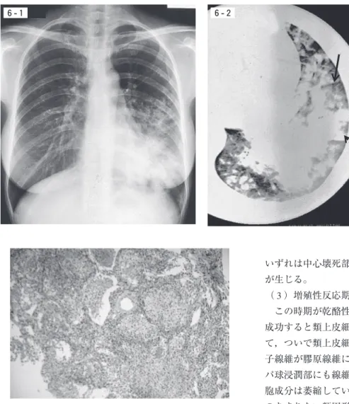 図 7 繁殖性反応期の肺病巣（気管支鏡下肺生検材 料）。肺胞内は多数の細胞からなる肉芽腫からできて いる。 図 6 - 1 新病変の出現した肺結 核。右鎖骨下に小空洞性病変が みつかって紹介された女性患者。その 3 日後に高熱をだし再診したとき撮られた胸部単純写真。左下葉に新たに広範な浸潤影がみつかった。図6 - 2 同一患者の胸部 CT像：実線矢印にあるような小葉間隔壁が胸膜直下にいくつも観察される。これは経気道的に結核菌が多量に散布した小葉（破線矢印）と散布しなかった小葉とが隣り合わせにできるためである