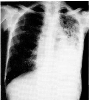 Fig.  2  Chest  X-ray  on  the  first  admission