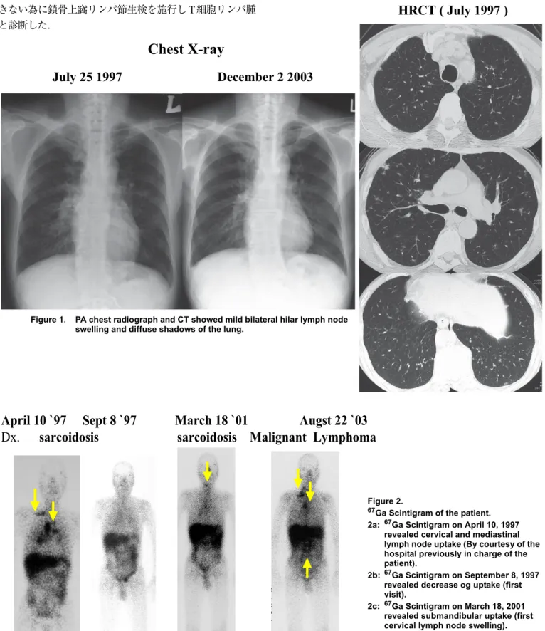 Figure 1. PA chest radiograph and CT showed mild bilateral hilar lymph node  swelling and diffuse shadows of the lung.