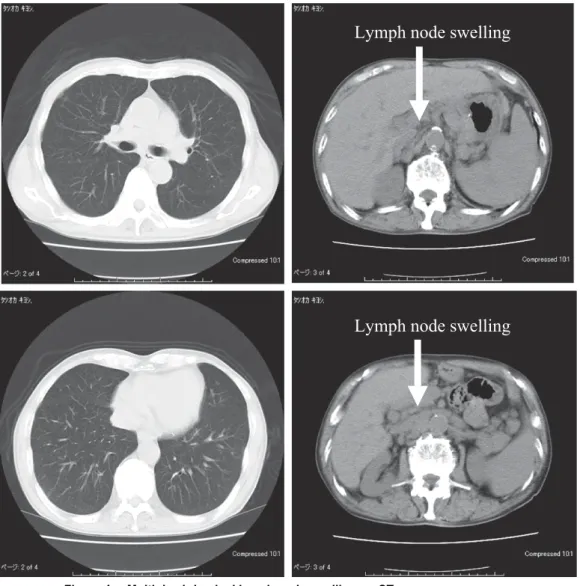 Figure 5.   Multiple cervical lymph node swellings and ossification of posterior longitudinal ligament on CT.