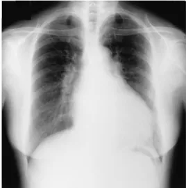 Figure 1  Chest X ray film on admission in July 1992.  