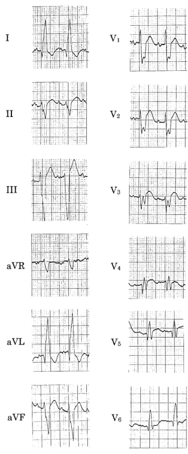 Figure 4  Electrocardiogram on admission in July 1999,  showing right bundle branch block, left axis deviation,  and abnormal q waves in leads V5, V6.