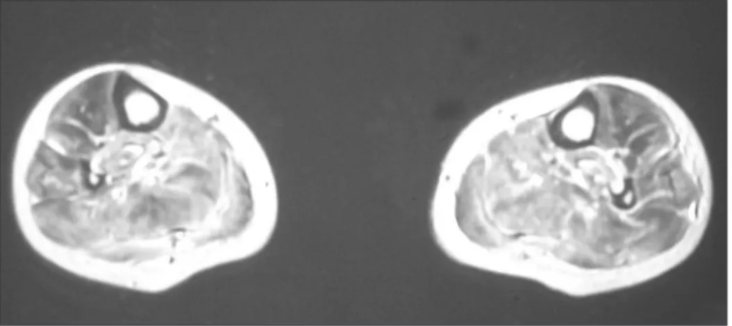 Figure 2a.   T2 weighted image of MRI on admission, showing diﬀuse hyperintensity in calf muscles.