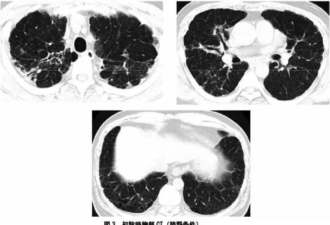 図 3. 初診時胸部 CT（肺野条件） 