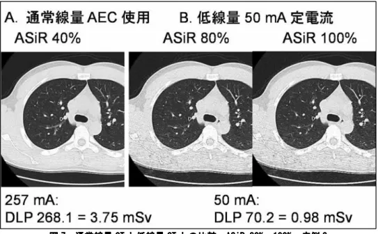 図 7. 通常線量 CT と低線量 CT との比較  ASiR 80%、100%：症例 3  ASiR80%、100%の画像では streak artifact による線状構造が断裂し、 