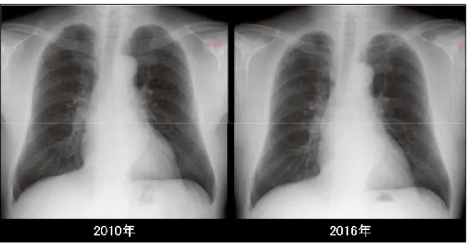 図 5. 胸部 X 線写真 
