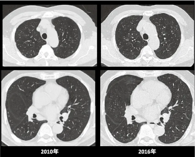 図 6. 胸部 CT 画像  図 7. 呼吸機能検査    20406080100 2010/4 2010/10 2011/4 2011/10 2012/4 2012/10 2013/4 2013/10 2014/4 2014/10 2015/4 2015/10 2016/4 2016/10％ＶＣＦＥＶ1.0/ＦＶＣ％ＦＥＶ％ＤＬＣＯ％