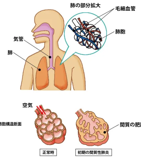 図 1.  肺の構造と間質性肺炎 