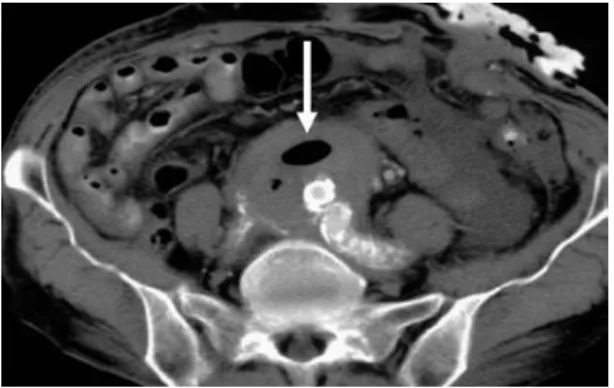 Figure 8 Contrast-enhanced computed tomogram after stent  graft deployment. There is no endoleak, however, air exists in  the pseudoaneurysm (arrow).