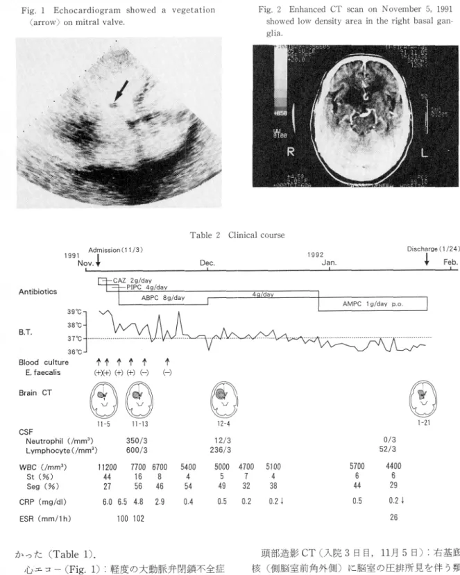 Fig.  1  Echocardiogram  showed  a  vegetation (arrow)  on  mitral  valve.