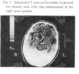Fig.  3  Enhanced  CT  scan  on  November  13 showed low  density  area  with  ring  enhancement  in  the right  basal  ganglia.