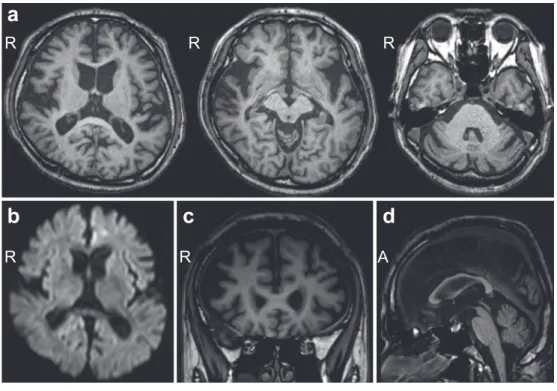 Fig. 1　Brain MRI.
