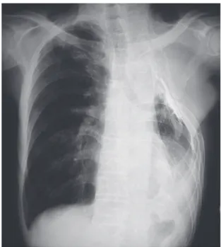 Fig. 2 Chest radiograph shows the left ribs from ﬁrst to 6th resected  and the volume decrement of left lung due to thoracoplasty.