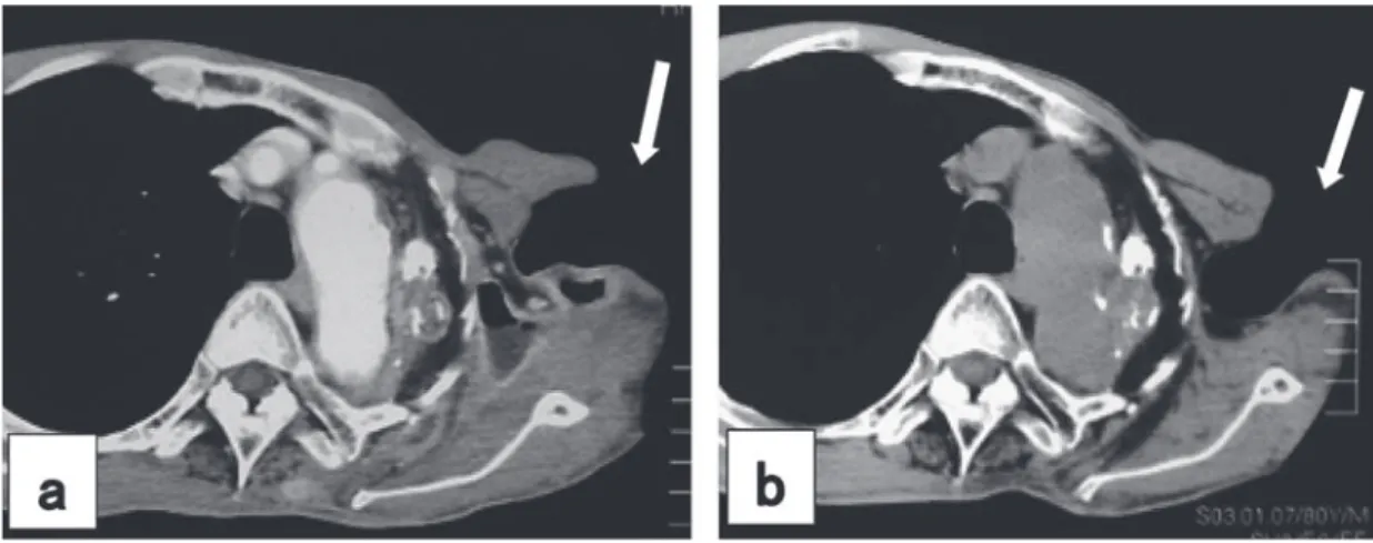 Fig. 5 Chest CT scan shows the abscess from left axilla to posterior thorax became smaller  after 2 months treatment (Fig