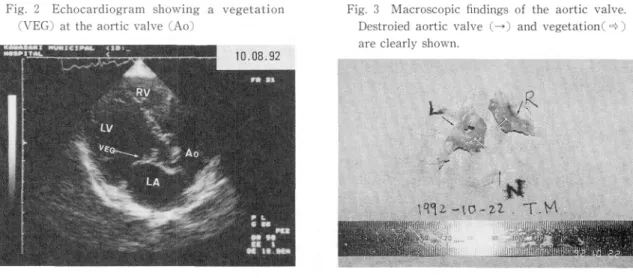 Fig.  2  Echocardiogram  showing  a  vegetation (VEG)  at  the  aortic  valve  (Ao)
