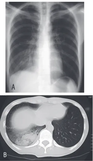 Fig. 3 Chest X-ray (A) and CT scan (B) showed a new  intra-pulmonary inﬁltrative shadow.