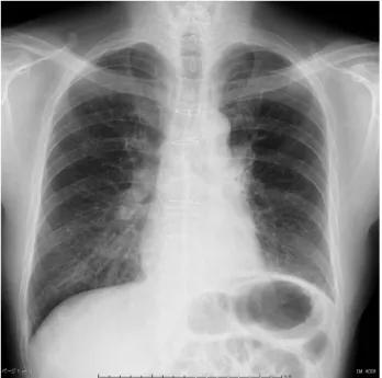 Fig. 1　Chest X-ray showed diffuse nodular shadows in bilateral  lower lung fields.